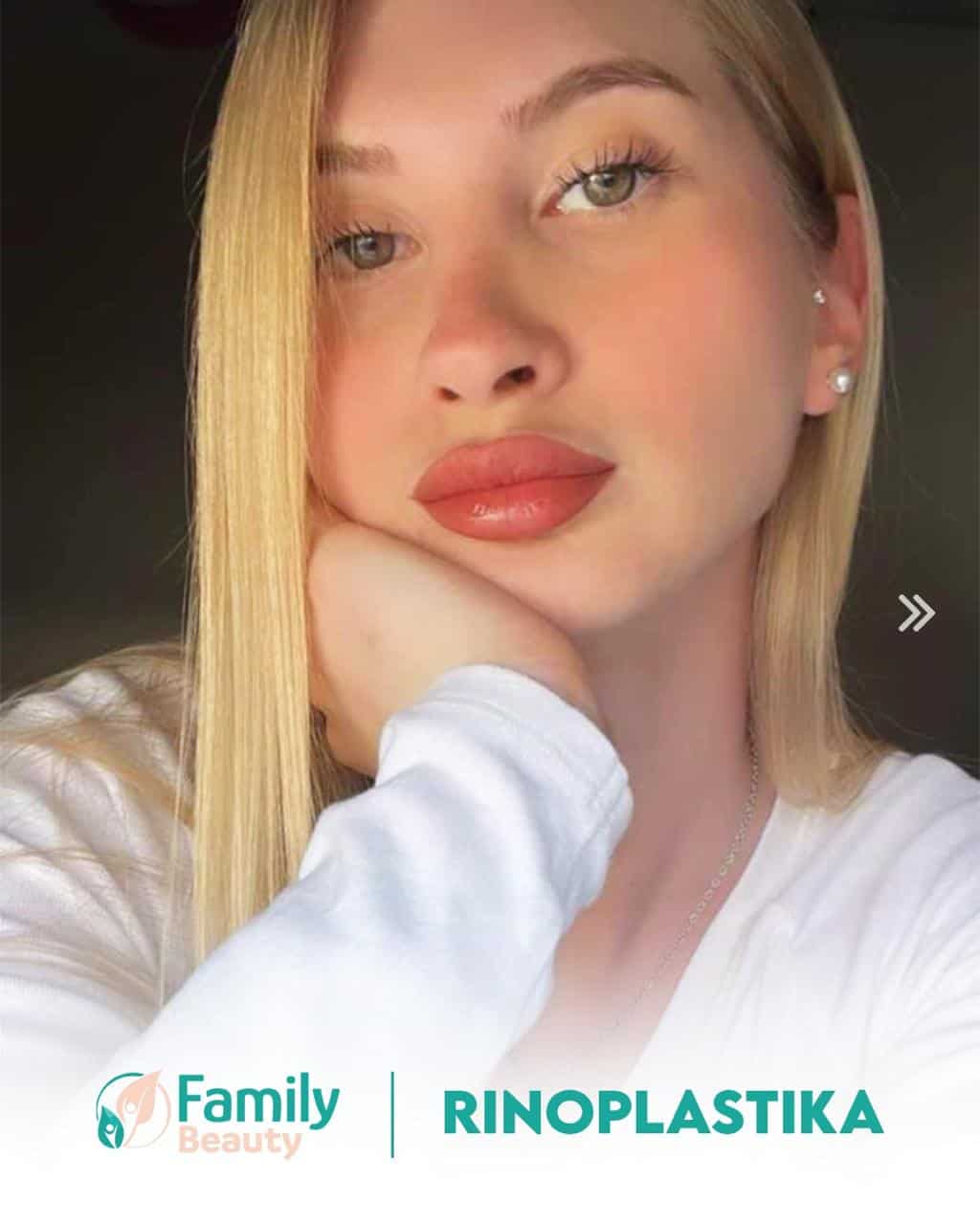 Rhinoplasty in Albania