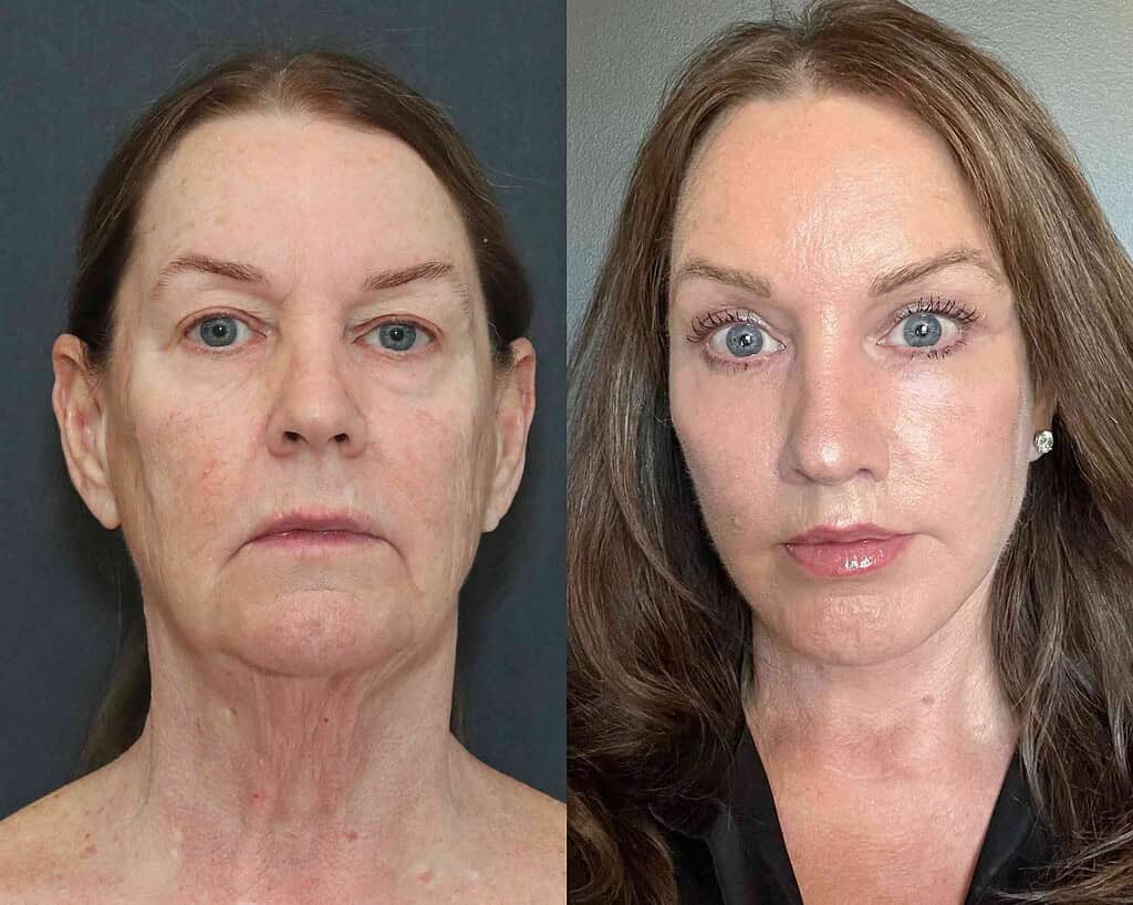 Prima e dopo il lifting