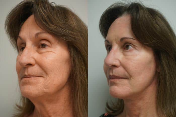 facelift-299-lato destro-anteprime (1)