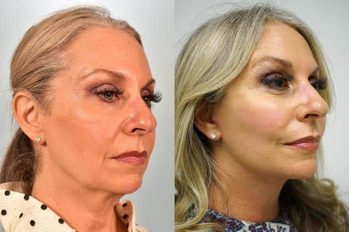 facelift-454-destra-obliquo-thumbnail