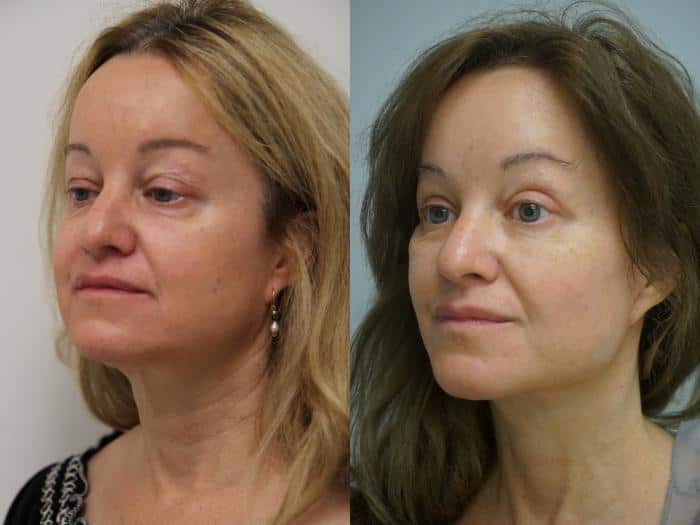 facelift-96-view-1-thumbnail (1)