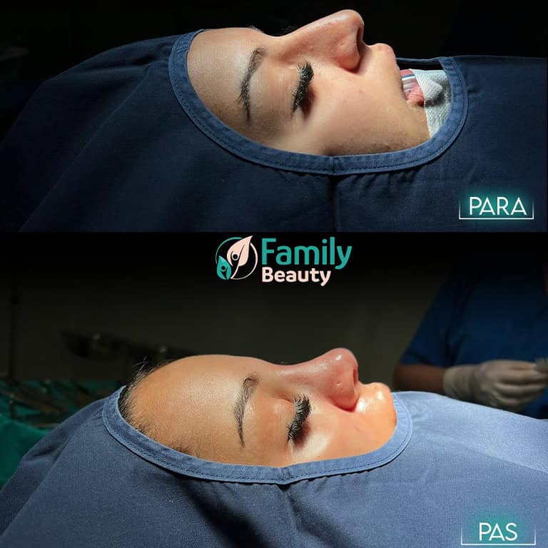 nose plastic surgery in Albania