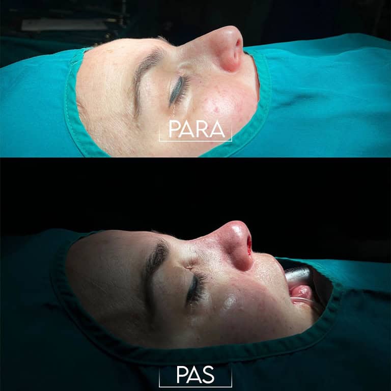 nose surgery for women in Albania